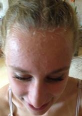 acne before treatment